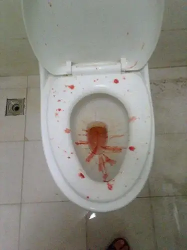 吐血图片 (25)_有来医生