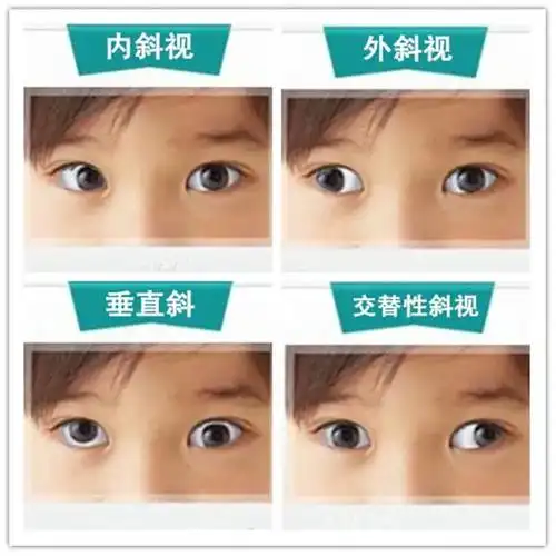斜视不及时治疗会影响孩子一生,如何尽早发现孩子斜视?