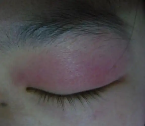 求助,女朋友上眼皮红肿了2个多月了,求医无门