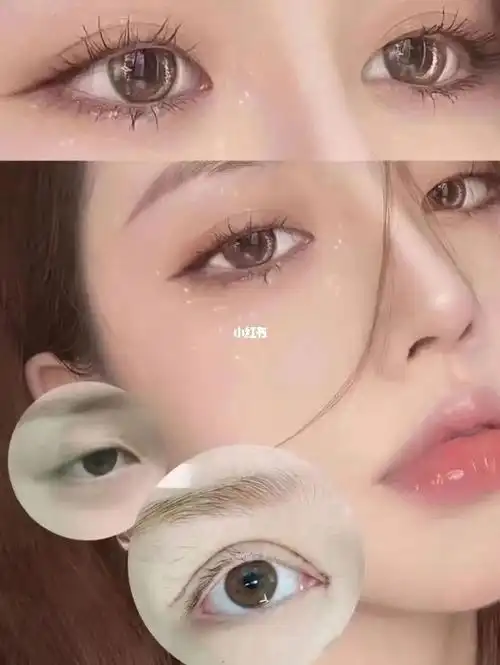 平行芭比眼综合