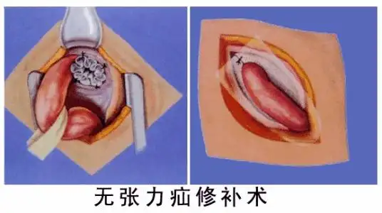 杭州复旦儿童医院冯志刚看疝气补片修补术治疗小儿疝气好吗_手术