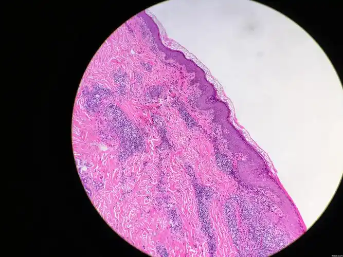 面部皮肤斑块 - 皮肤病理 - 91360病理论坛