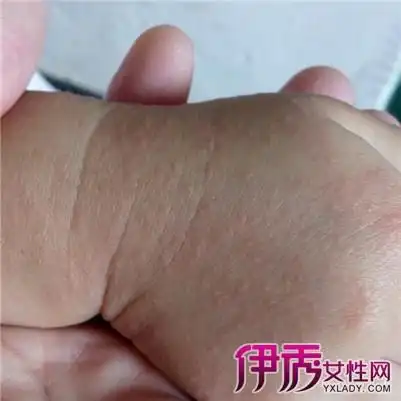 【图】小孩手湿疹图片大全 其症状及注意事项大盘点