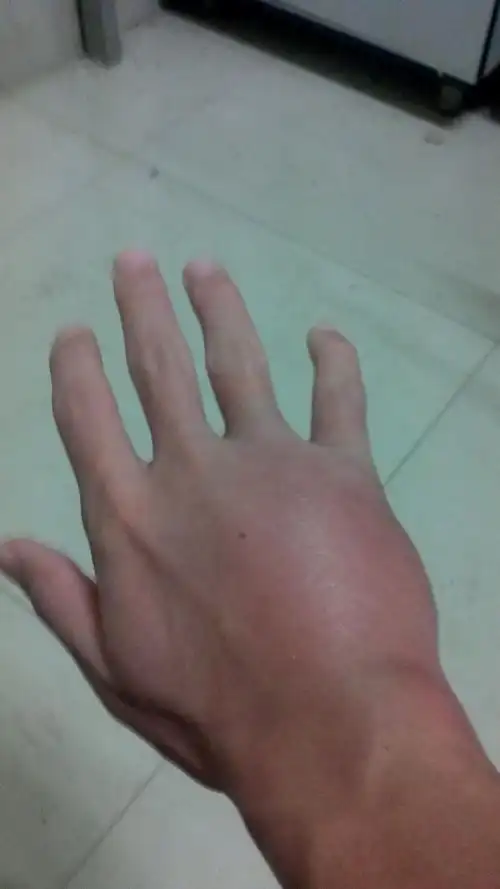 是打中小拇指,刚开始没怎么痛,只是手背上有个地方凸起,早上就肿的肥