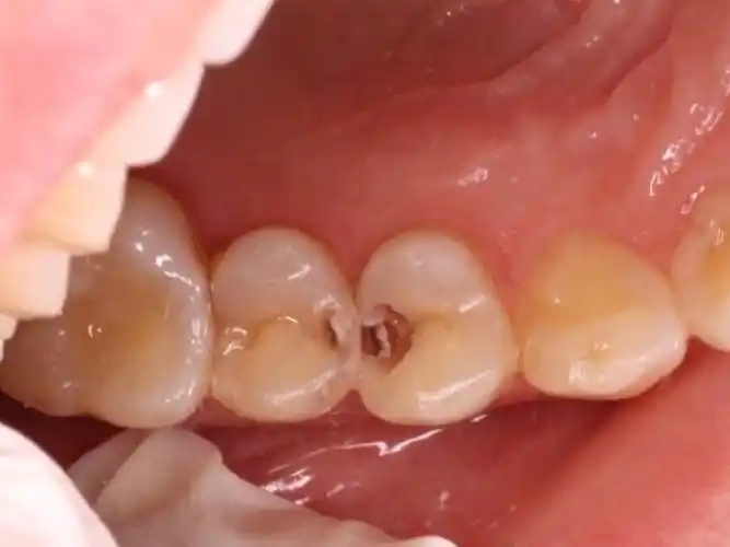 突然发现牙齿有了个洞,应该是虫蛀了,就想着处理下.