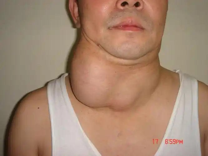 甲状腺腺瘤的治疗方法