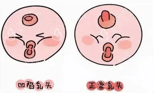 深圳艺星医疗美容医院乳头凹陷示意图