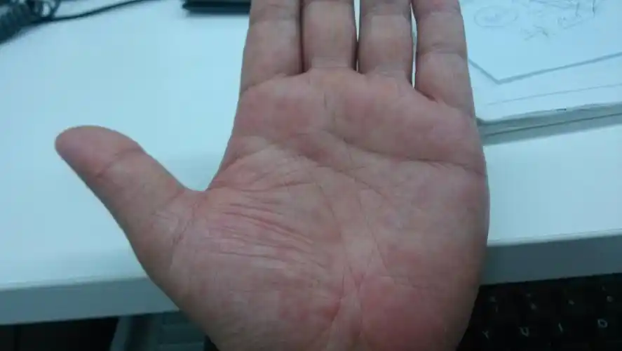 我的手掌斑点状发红,还有点痒,还有小的爆皮现象