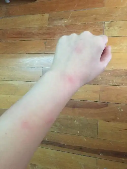 很痒 ,消下去很慢,是螨虫咬的么?还是湿疹?