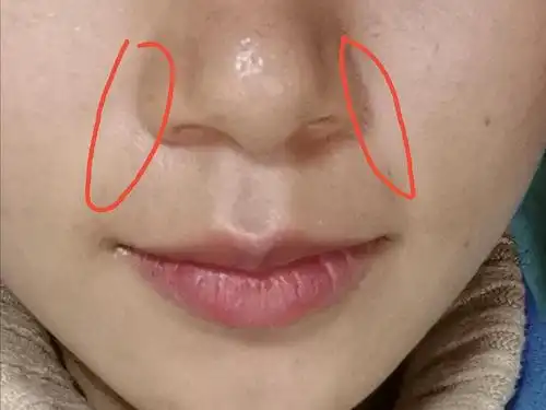 有没有集美和我一样鼻子旁边有两道凹槽