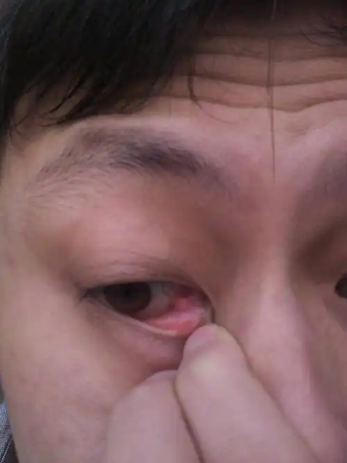 眼角膜上长个肉粒,不知道是什麼,有四五年了,不疼不痒,也没有异味,有