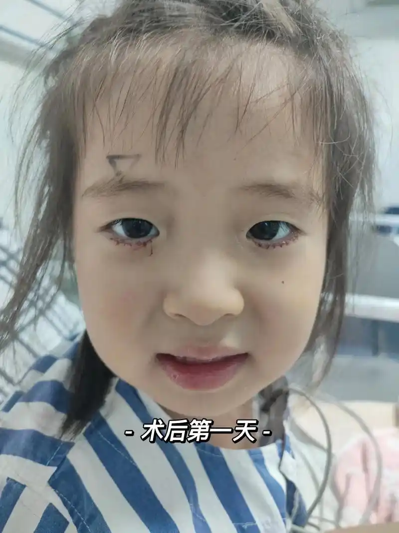 倒睫手术,7878柚子勇敢的一次,比想象中的还要听话,恢复的半个