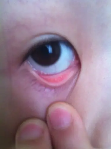 问:眼睛里面有白色的小颗粒.不痛不痒.