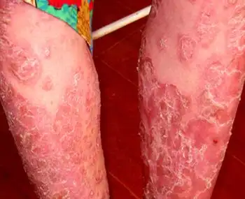 红皮型牛皮癣怎么治