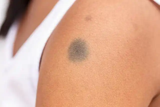 新生儿有"青屁股",是疾病的前兆?辟谣:这4种胎记才要警惕