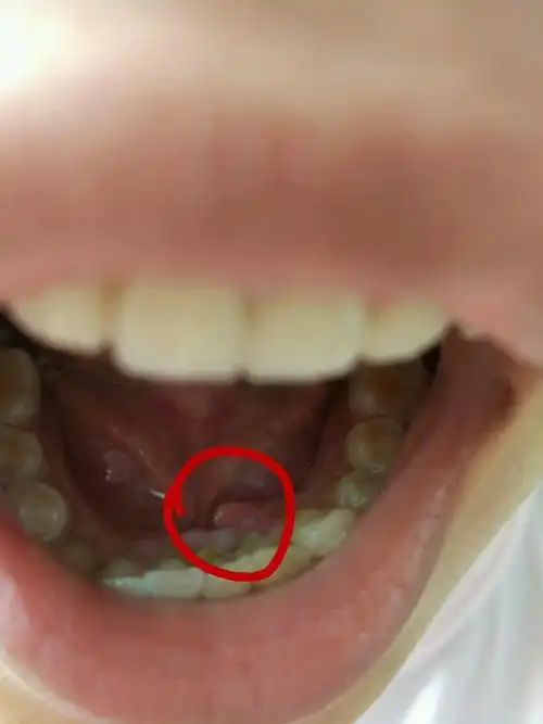 口腔内长了一个米粒大的小肉球