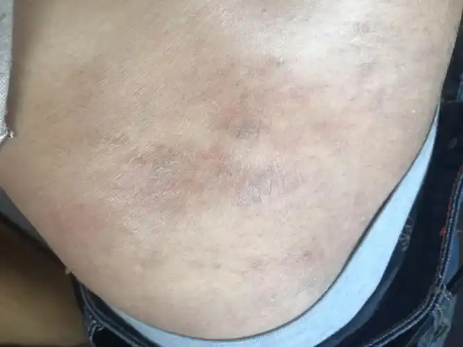 最近突然发现腰两侧和后背一块一块发黑,而且有脱皮,请问是怎么回事儿