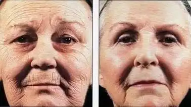 我妈坚持防晒二十年变化,长期防晒和不防晒对比