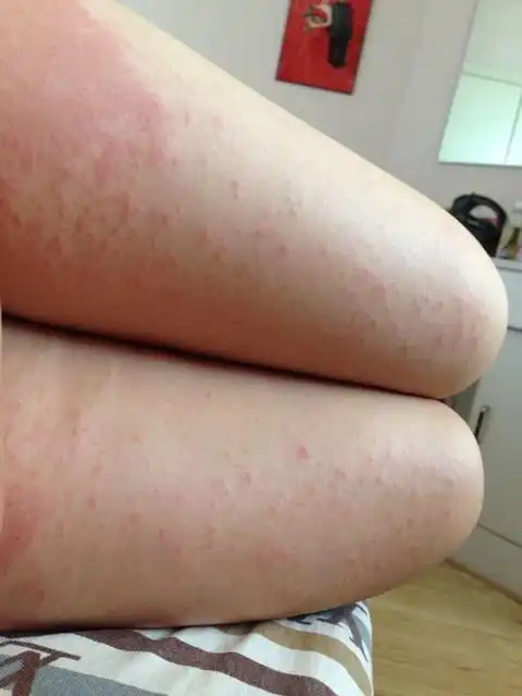 肚子和手臂,大腿都长了好多湿疹怎么办呀?