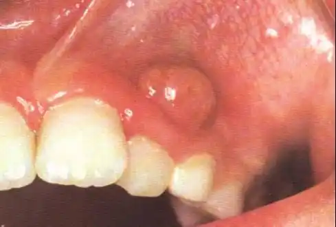 根尖周炎有哪些症状?