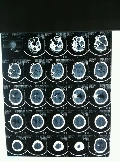 高血压脑出血的微创治疗