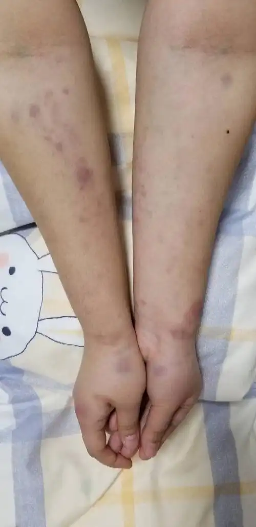 打了两天排球,胳膊变成这样正常吗?