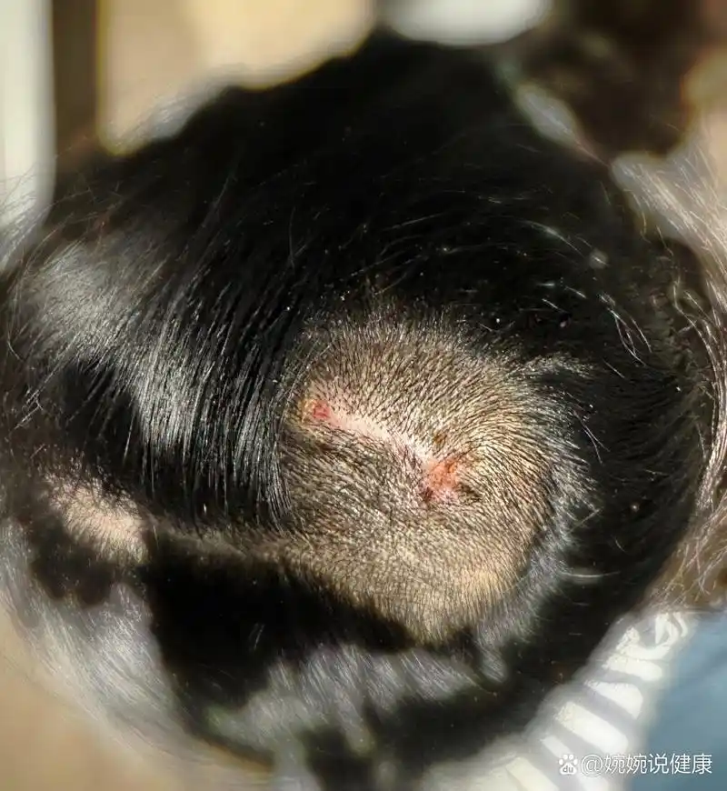 皮脂腺痣手术毕业啦95 从小我头顶就长了一块凸出的东西 家里人告诉