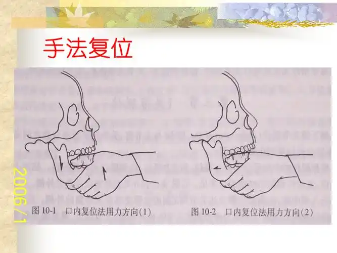 颞下颌关节脱位