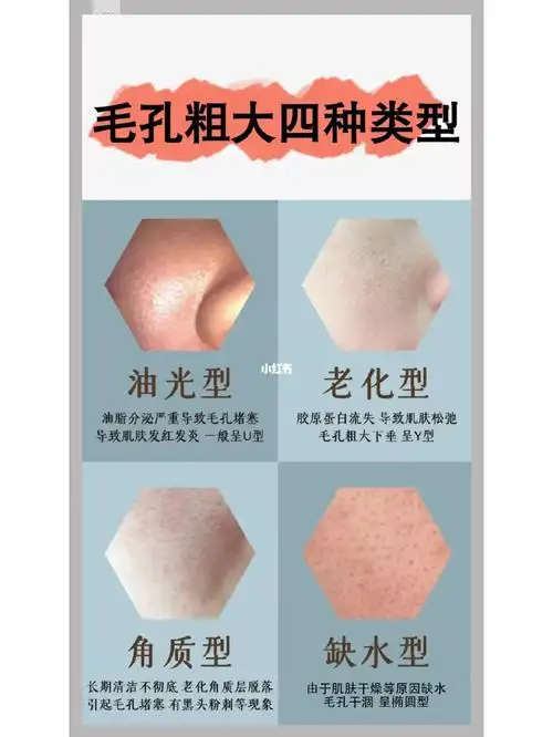 毛孔粗大的四种类型
