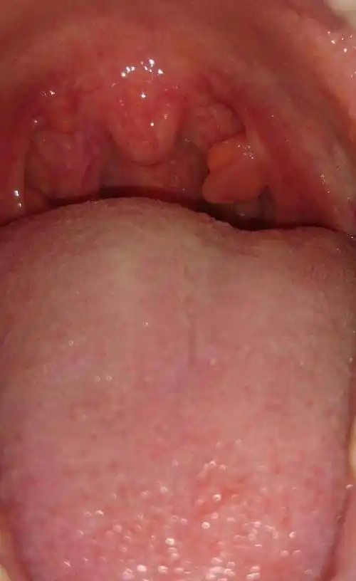 请问扁桃体上长的这个是什么呀,不痛不痒的