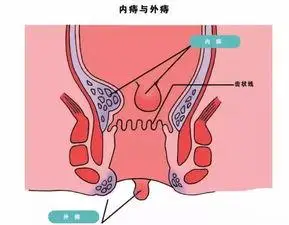 痔疮是什么样子