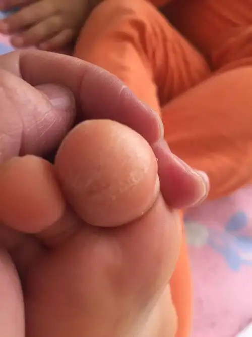 帮我看看宝宝的脚趾怎么了