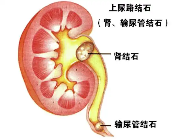 宝鸡蔡家坡医院急腹症之输尿管结石