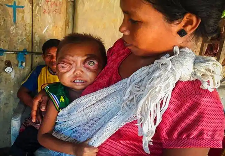 印度2岁童患眼疾,眼珠肿大到快掉出来,样子让人落泪!