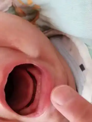 牙床上冒的白色点点要不要紧呀!有没有影响!