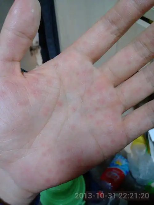 09:47李庆辉医师 回答: 病情分析: 你好,这种情况,是湿疹,汗疱疹