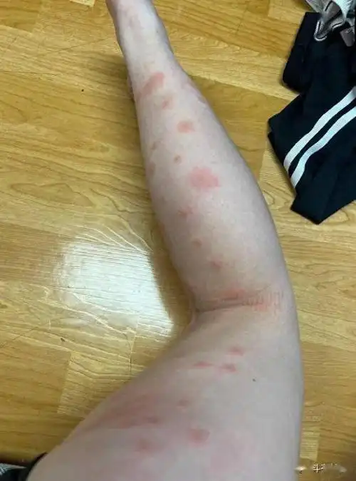 欧洲人把臭虫带进韩国快速占领酒店和大学会蔓延到中国吗