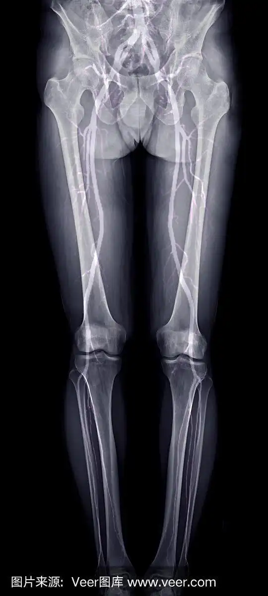 下肢x线或合并cta的x线影像显示下肢的骨和血管.