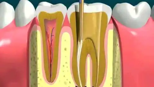 动画演示根管治疗全过程,打桩做牙冠!