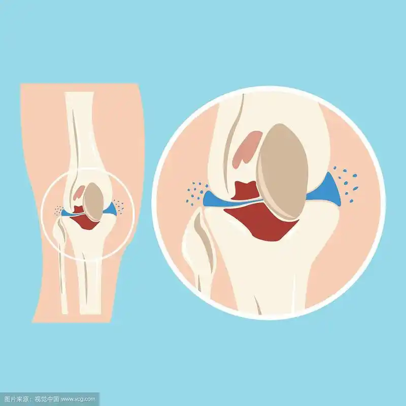 人体膝关节软骨损伤