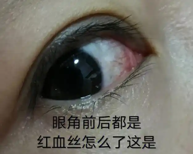 眼睛红血丝挺一个月没好,还是看医生好的快
