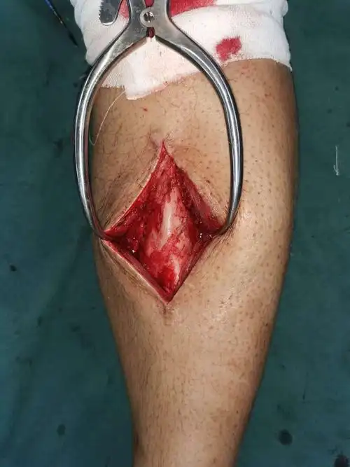 见左胫骨骨折端为纤维组织填充,无连续性骨痂,无明显的炎性渗出物