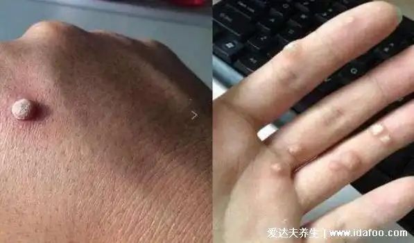 女性hpv初期症状图片大全表现4种现象