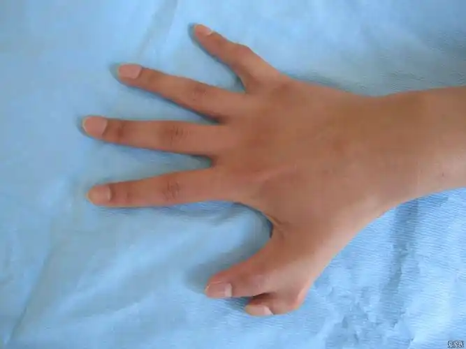 六指畸形一例直接上图
