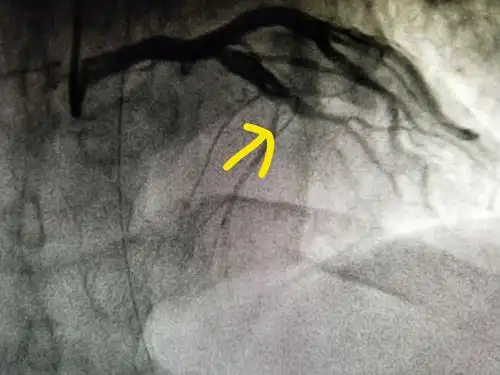冠脉造影示:前降支中段100%闭塞,为此次心肌梗死之罪犯血管
