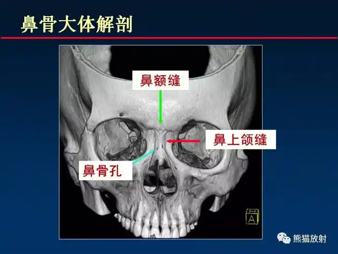 鼻骨骨折一直都是打架斗殴伤脑筋的诊断,大家一定要