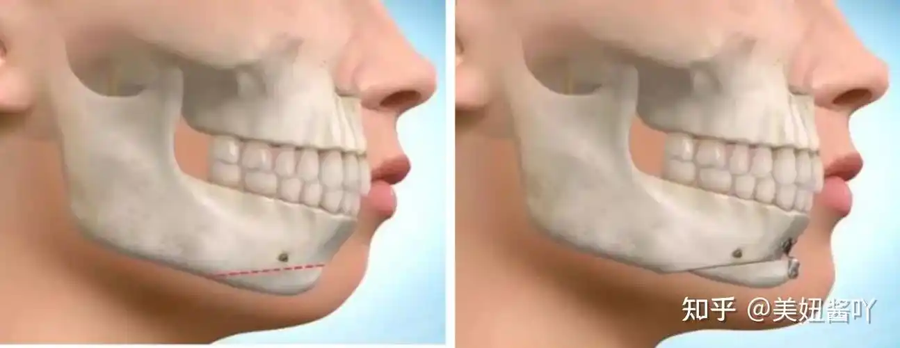 做正颌手术有哪些风险想做正颌之前先看看这篇