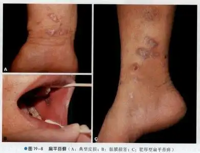 治疗扁平苔藓的偏方有哪些