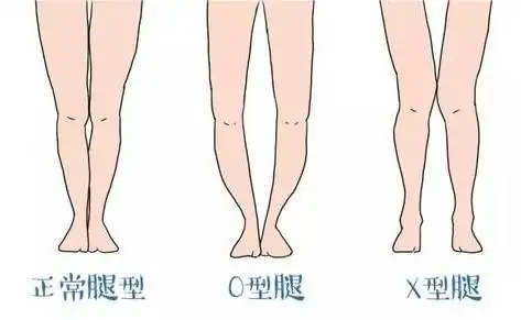 小马快跑早教育儿:宝宝站立得过早会变o,x型腿,这是真的吗?
