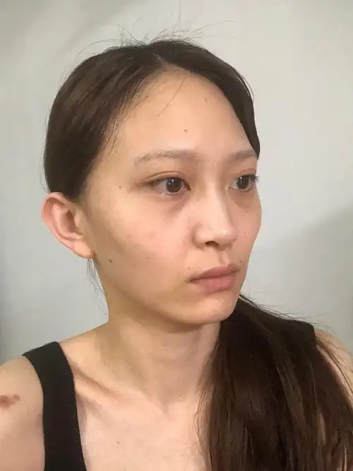 我觉得女生的面部扁平凹陷真的是有点显老,我的面部就_圈子-新氧美容